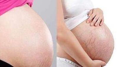 怀孕中期妊娠纹痒怎么办 妊娠痒纹止痒方法