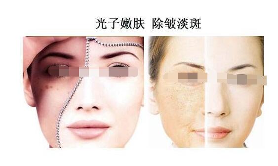 做光子嫩肤会有副作用吗 光子嫩肤做完注意事项 