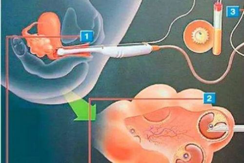 女大学生捐卵20颗赚3万5 最后的遭遇却让人叹息 