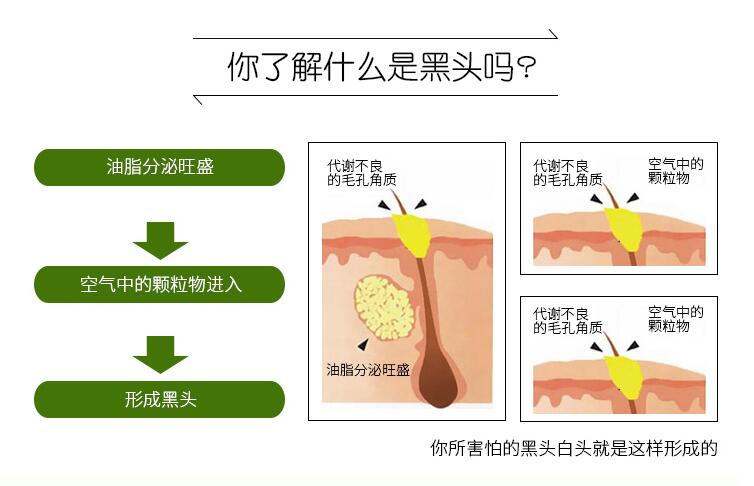 粉刺黑头怎么去除