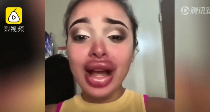 美女丰唇手术失败录视频哭诉“该咋办” 网友却笑疯(现场)