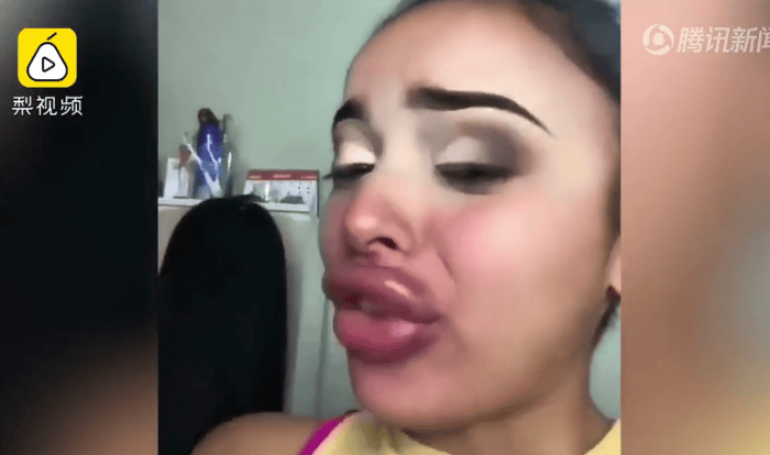 美女丰唇手术失败录视频哭诉“该咋办” 网友却笑疯(现场)